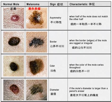 背上長痣|痣也可能会癌变！长在 3 个地方要注意